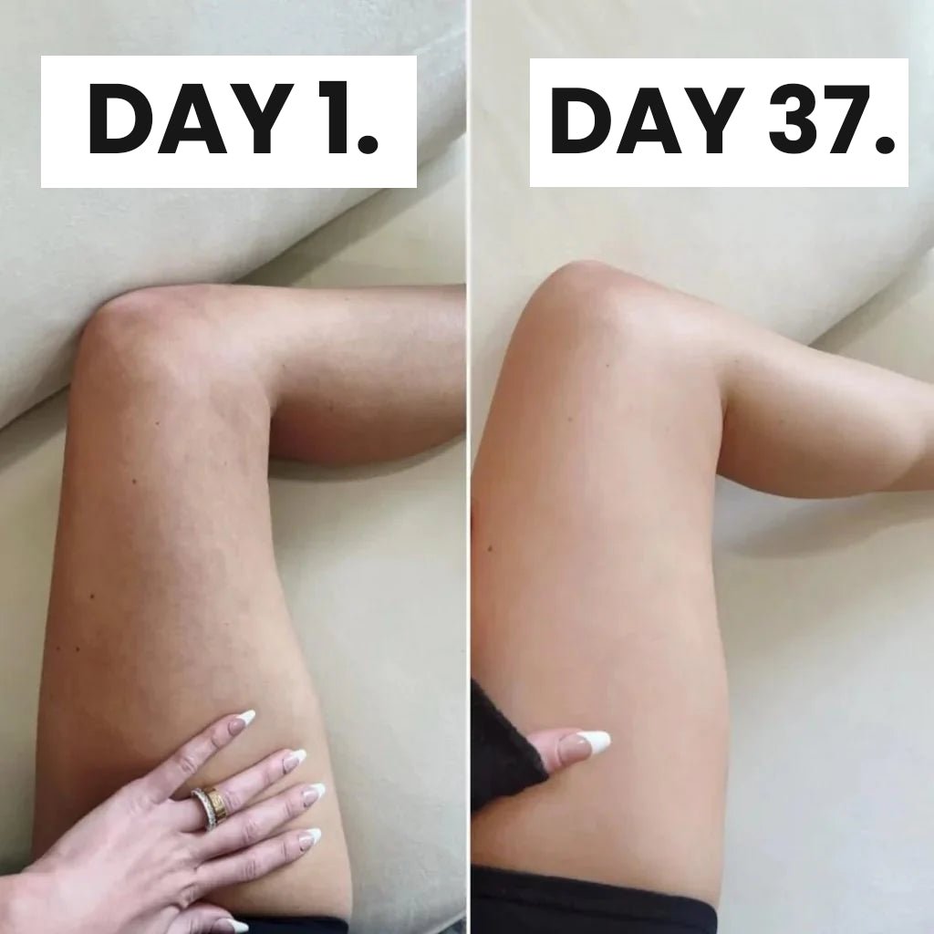 CurveRevive™ Cellulite Massage Kit - Before & After Comparison