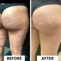 Before and after results showing smoother skin on thighs using CurveRevive Electric Vacuum Cupping for cellulite reduction.